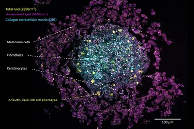 Cancer Spheroid 02 Kid21756033