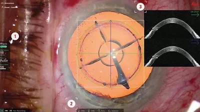 Software Generated Image Of The Surgical Cockpit View Of Proveo 8x Kid21774753